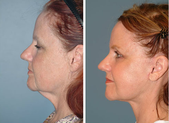 Neck Lift before 575391