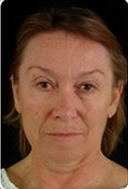 Face and neck lift before 6744