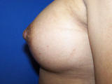 Nipple Repair after 124937