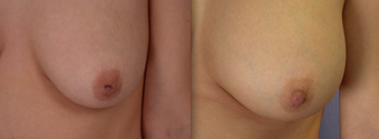 Nipple Surgery before 293261