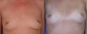 Nipple Surgery before 293275