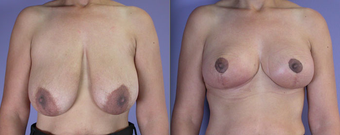 Nipple Surgery before 293279