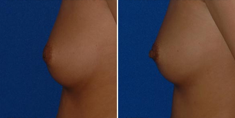 Nipple Surgery after 495857