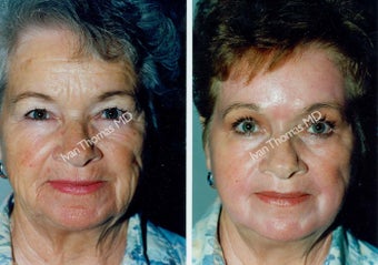 Non-Surgical Face Lift- Exoderm before 242973