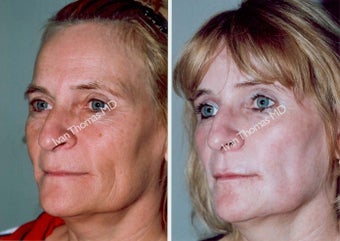 Non-Surgical Face Lift- Exoderm before 242981