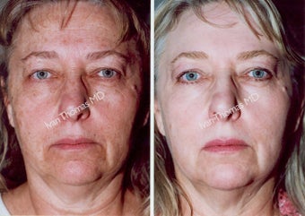 Non-Surgical Face Lift- Exoderm before 242982