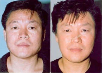 Non-Surgical Face Lift- Exoderm before 242989