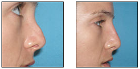 Non-Surgical Nose Job before 627870