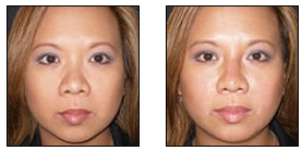 Non-Surgical Nose Job before 627871