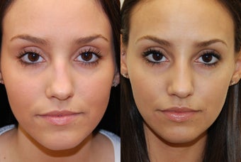 Non-Surgical Rhinoplasty with Silikon-1000. 3 treatments. before 388357