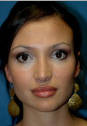 Rhinoplasty after 317174