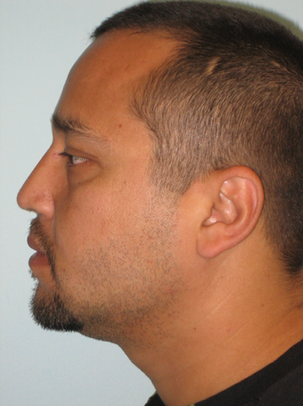 Nasal Reconstruction after 332434