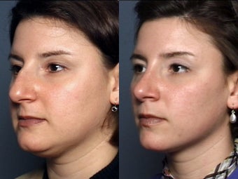 Nose Surgery after 338487