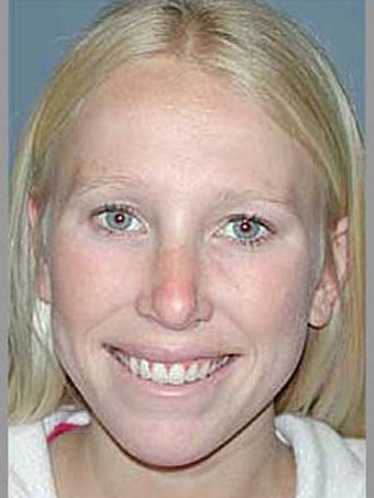 Rhinoplasty after 510118