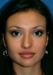 Rhinoplasty before 317174