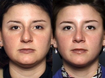 Nose Surgery before 338487