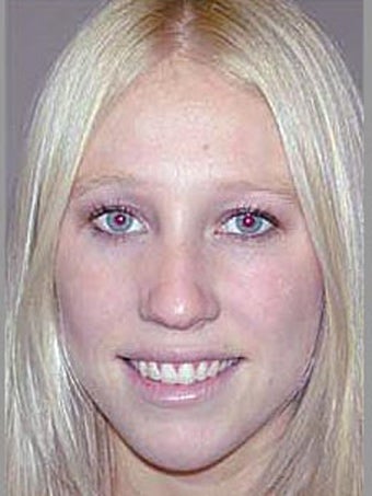 Rhinoplasty before 510118