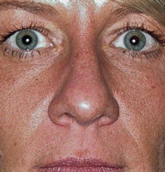Rhinoplasty before 536181