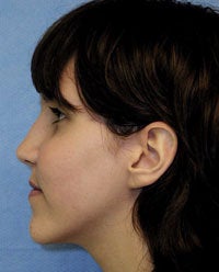 Orthognathic Jaw Surgery, Setback of Lower Jaw after 519682