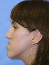 Orthognathic Jaw Surgery, Setback of Lower Jaw before 519682