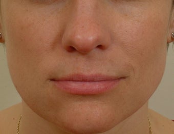 Pearl Laser Treatment after 102780