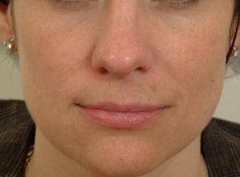 Pearl Laser Treatment before 102780