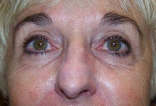 Pearl Fractional Laser before 156996