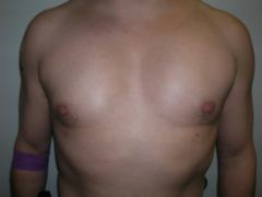 Pec Implants after 259004
