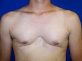 Chest Wall Reconstruction Surgery before 145937