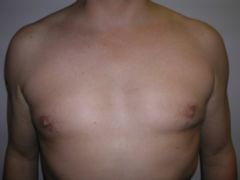 Pec Implants before 259004