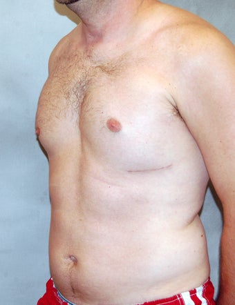 Male Chest Enhancement after 525472