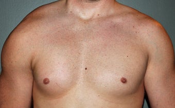 Pectoral Implants after 536031