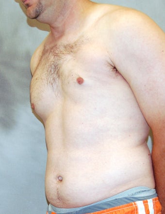 Male Chest Enhancement before 525472