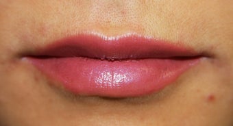 Lips after 398400
