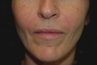 Perlane Injections after 451840