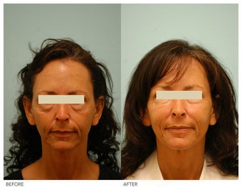 Injectable Fillers (Restylane/Perlane) before 136774