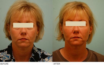 Injectable Fillers (Restylane/Perlane) before 136778