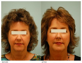 Injectable Fillers (Restylane/Perlane) before 136782