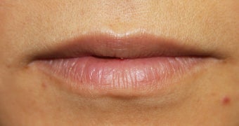Lips before 398400