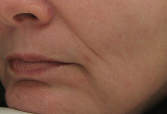 Nasolabial folds and Marionette lines after treatment with Perlane before 52831