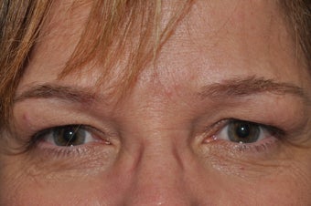 Permanent Eyeliner before 493479