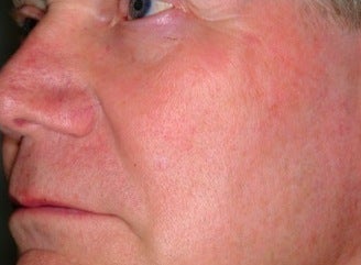 PDT treatment after 376117