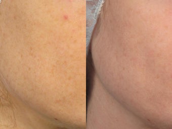 Photodynamic therapy - PDT before 256150