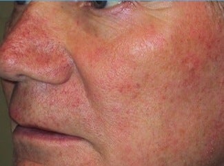 PDT treatment before 376117