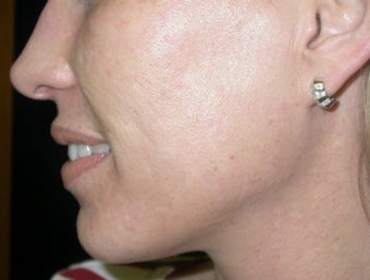 Acne scarring treatment after 122194