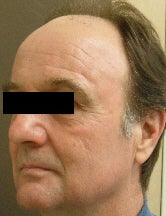Pixel laser after 177818