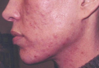 Acne scarring treatment before 122194