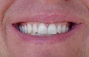 Porcelain Veneers after 109169