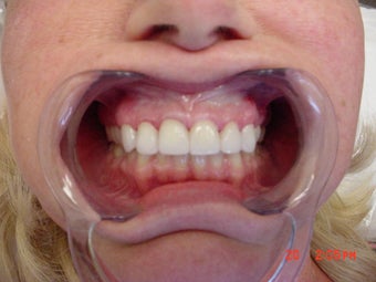 6 veneer after 360131