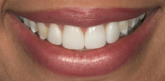 Porcelain veneers after 503134